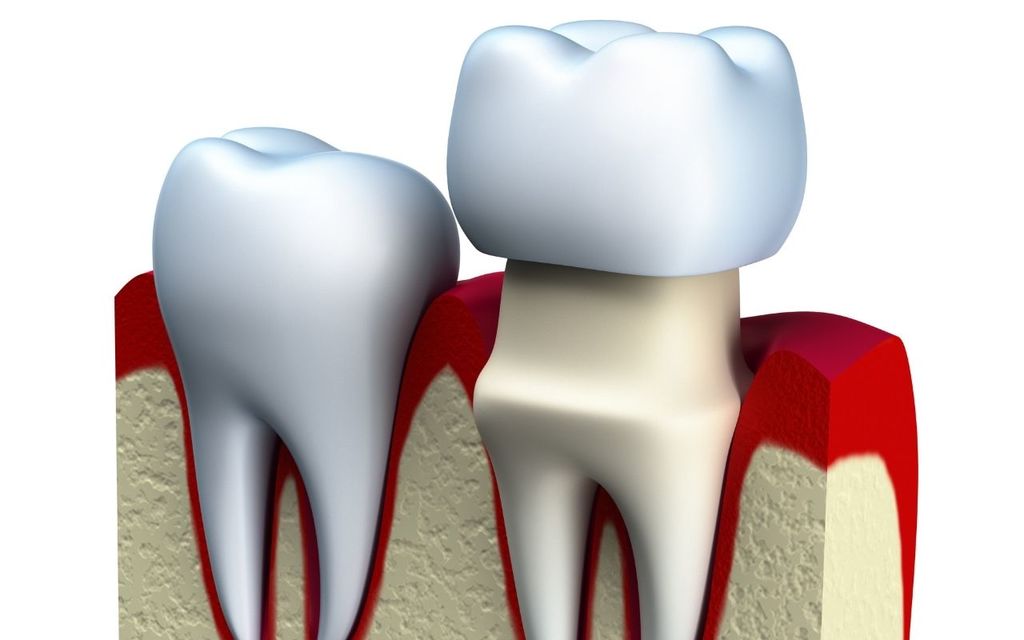 Dental Crown Cerec Etobicoke Dental-crown-caps-tooth-Same-Day-CEREC-Crowns-Etobicoke-Dentist