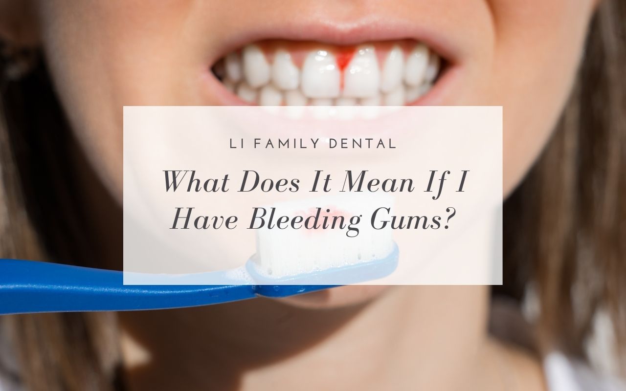 What Does It Mean If I Have Bleeding Gums? Li Family Dental