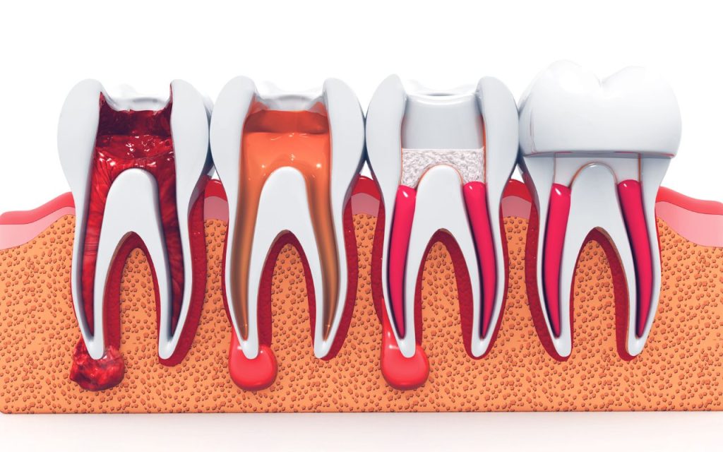 when-is-the-crown-placed-after-a-root-canal