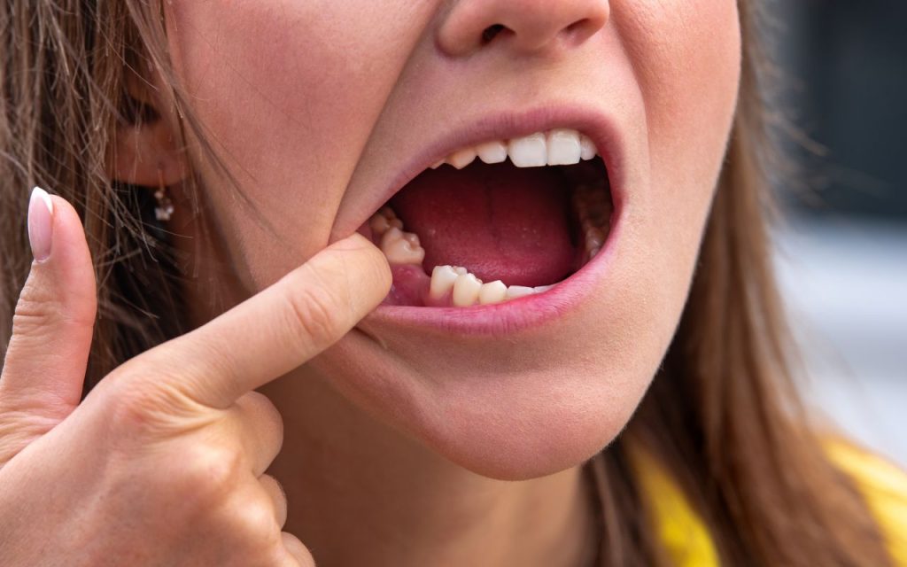 if-you-are-missing-teeth-you-may-need-dental-implants