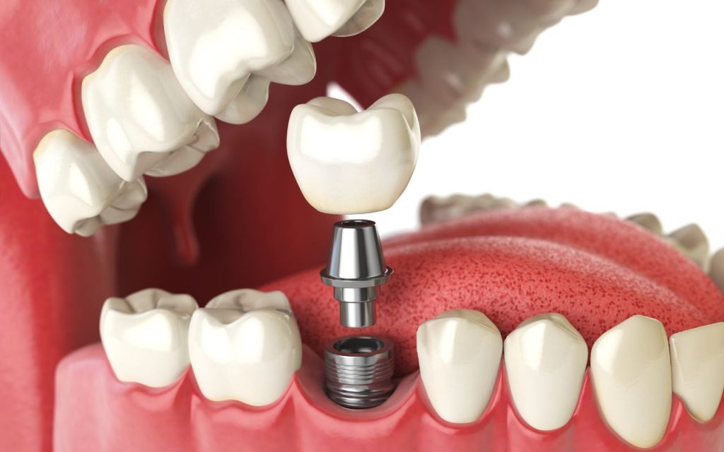 Illustration of a dental implant being positioned in an open mouth, showing the implant base, connector, and crown aligned with surrounding teeth and gums.