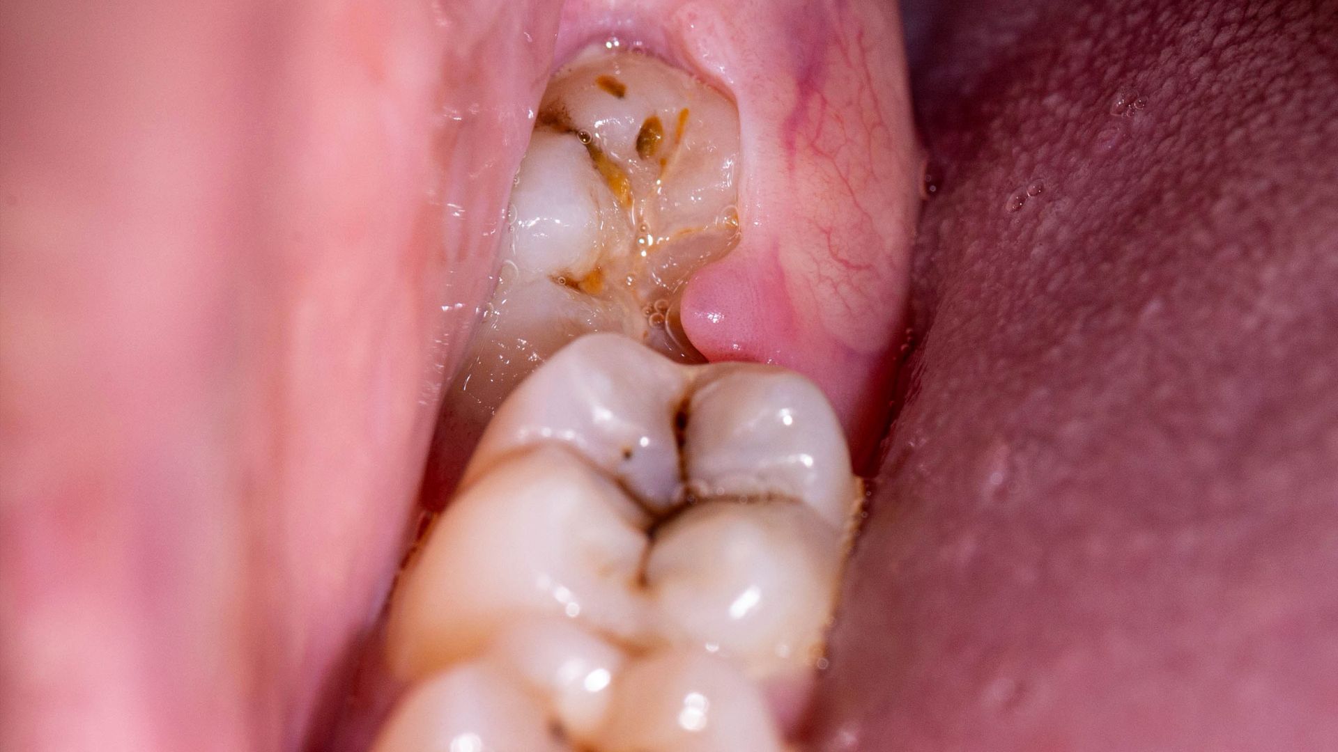 Pericoronitis Explained Symptoms Treatment And Care Tips Pericoronitis Explained Symptoms Treatment And Care Tips