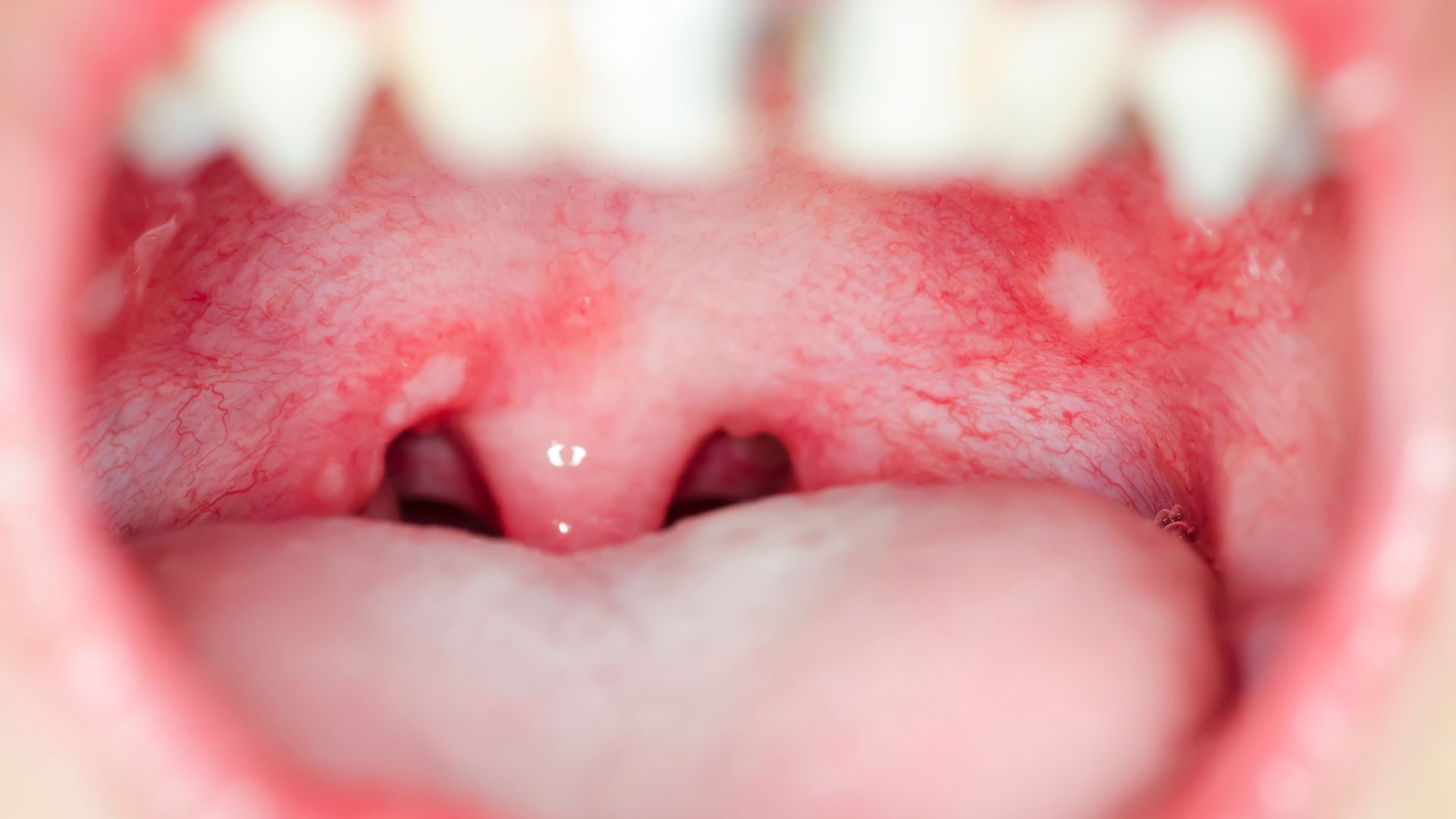 dental-screenings-can-detect-oral-cancer-in-its-early-stages