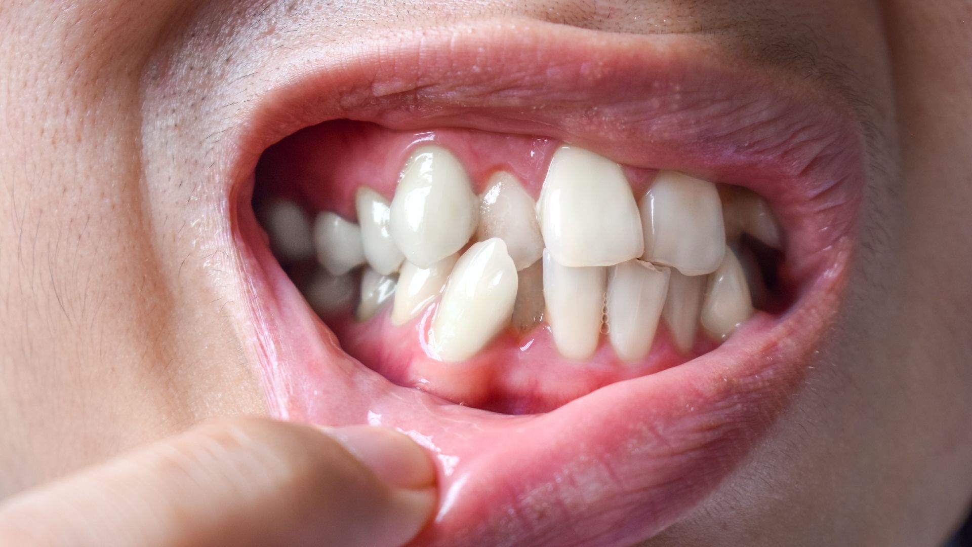 if-your-teeth-are-crowded-its-time-to-see-the-dentist