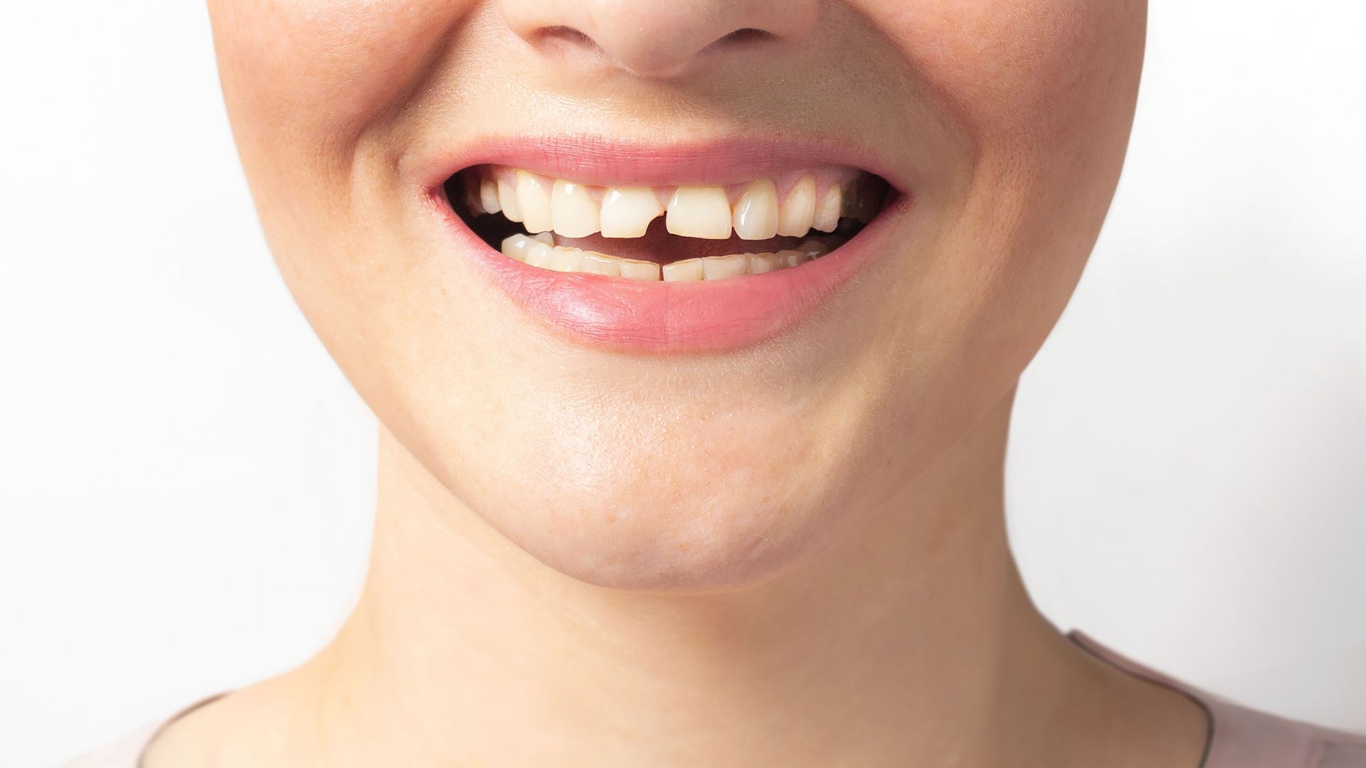 if-youve-got-a-broken-cracked-or-chipped-tooth-its-time-to-see-the-dentist