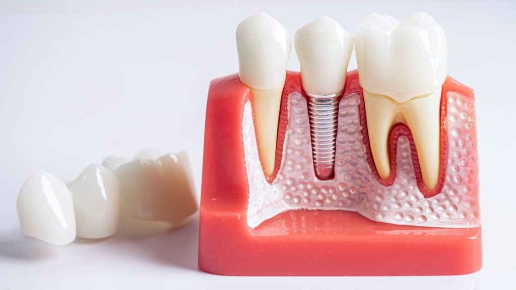 A dental model showing a dental implant with artificial teeth and gum tissue, alongside separate tooth crowns on the left.