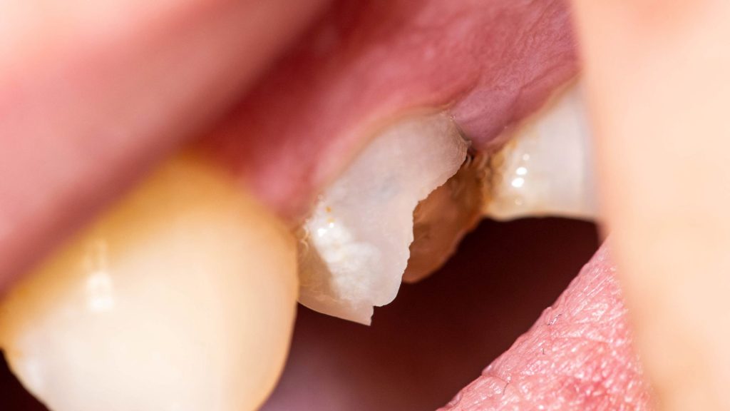 Close-up of a broken tooth with visible decay near the gum line, surrounded by healthy teeth and pink gums.