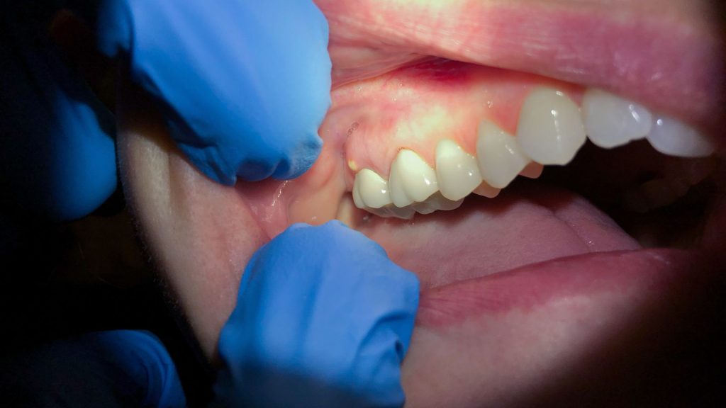 A close-up of a person's open mouth showing teeth and gums, with gloved hands holding the mouth open for examination.