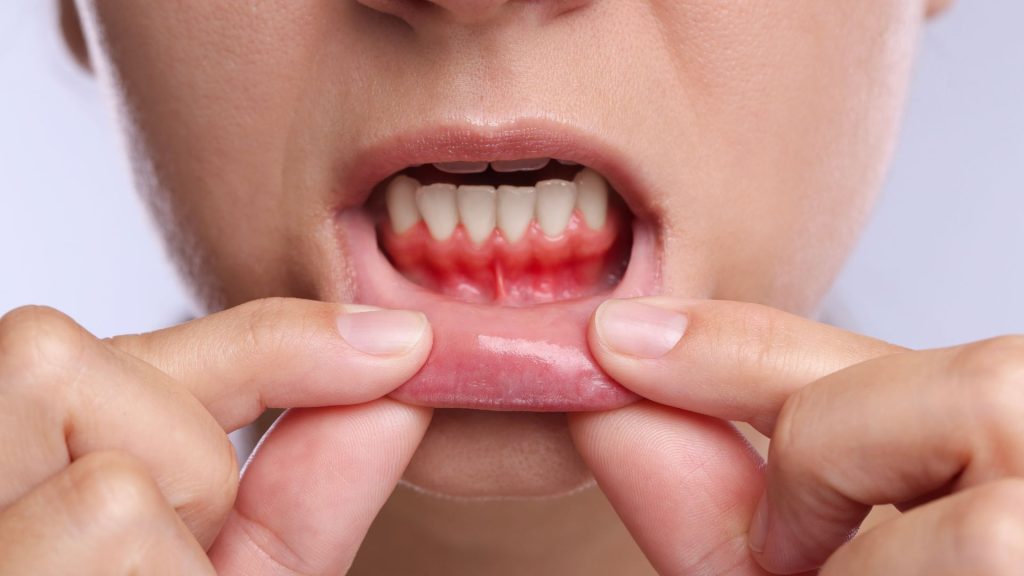 A person pulls down their lower lip to reveal red, inflamed gums and teeth, indicating possible gum disease or irritation.
