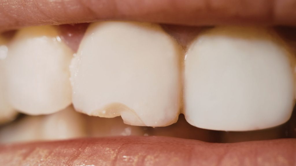 Close-up of human teeth showing a visible chip on one of the front teeth.