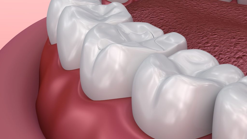 A close-up 3D illustration of human molar teeth and gums inside the mouth, with the tongue partially visible in the background.