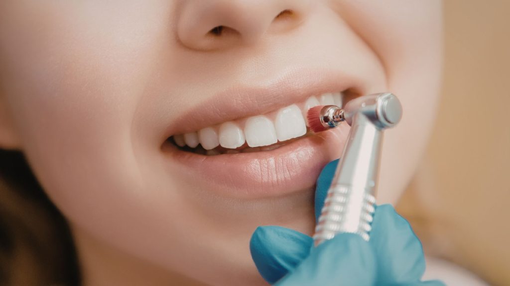 A dental professional uses a polishing tool on a patient's teeth, showing a close-up of the patient's smile and white teeth.