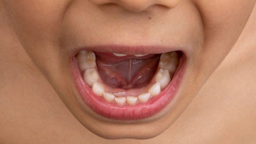 A close-up of an open mouth showing a child's lower teeth, with new adult teeth growing in behind the baby teeth—illustrating how children’s teeth erupt and fall out.