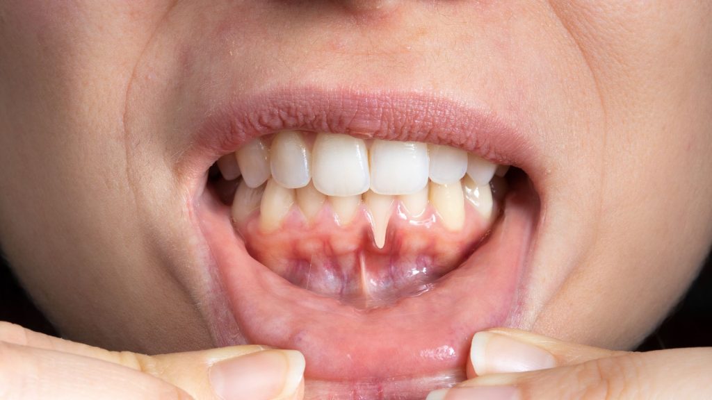 Can tooth sensitivity lead to bigger issues? A close-up of a person pulling down their lower lip to show the inner gums and teeth.