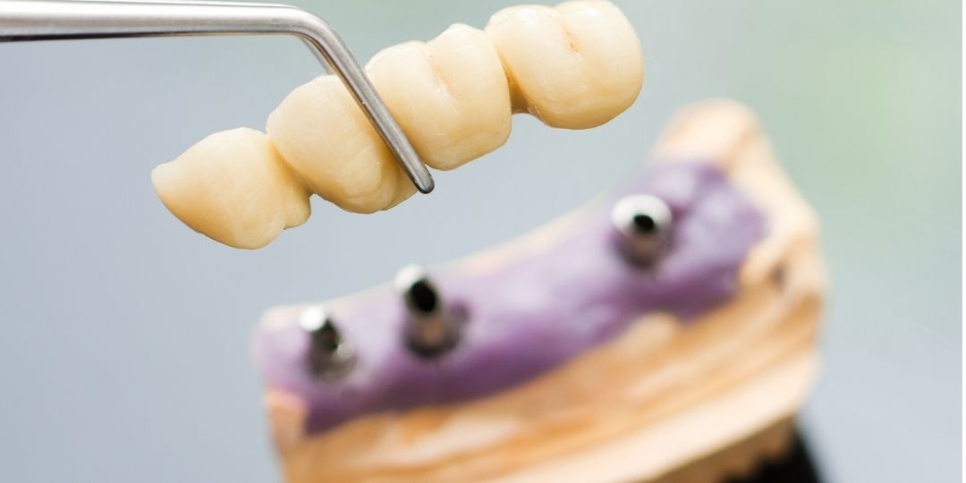 Dental bridge held by tweezers above a dental implant model with three metal posts.