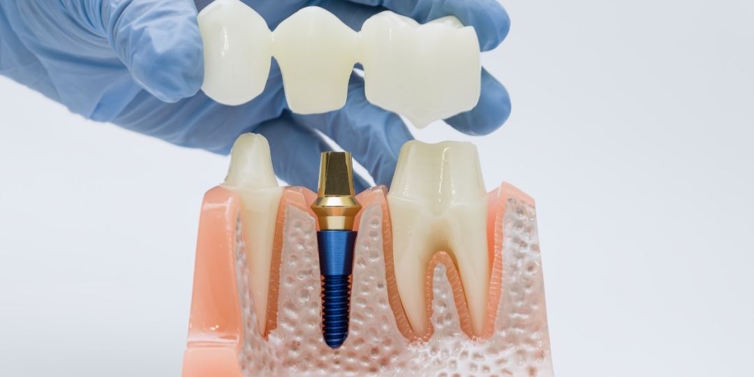 A gloved hand holds a dental bridge above a model showing a dental implant and two natural teeth within gum and jaw structure.