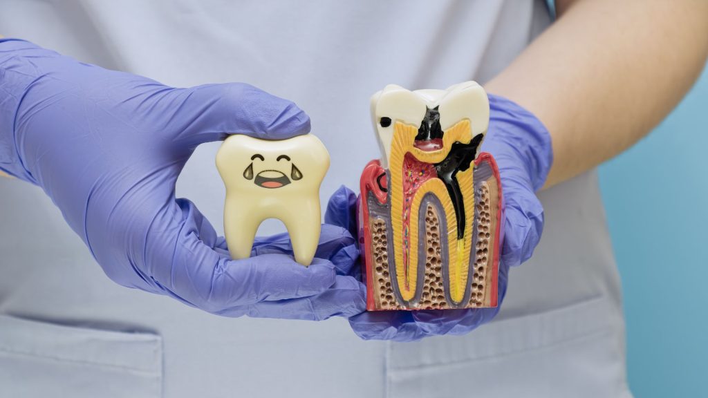 When tooth sensitivity could be a problem. A person wearing purple gloves holds a model of a smiling tooth and a cross-section model of a tooth with visible decay and cavities.