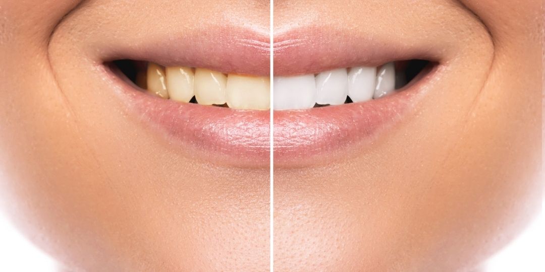zoom whitening - Close-up of a person's smile, showing a split view with yellowed teeth on the left side and whitened teeth on the right side.