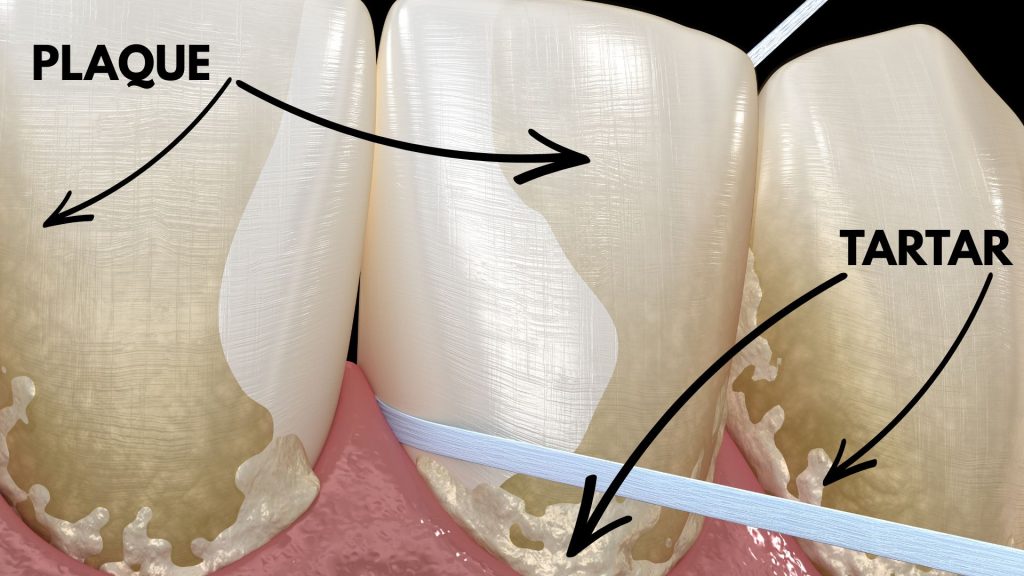 Illustration shows close-up of teeth with labeled areas highlighting the key differences between plaque and tartar near the gumline, and dental floss being used between the teeth.