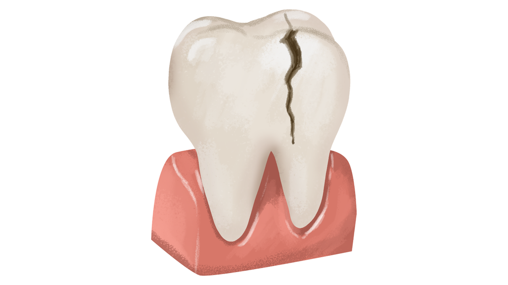 Illustration of a cracked molar tooth set in a section of pink gum, showing a visible vertical fracture down the crown.
