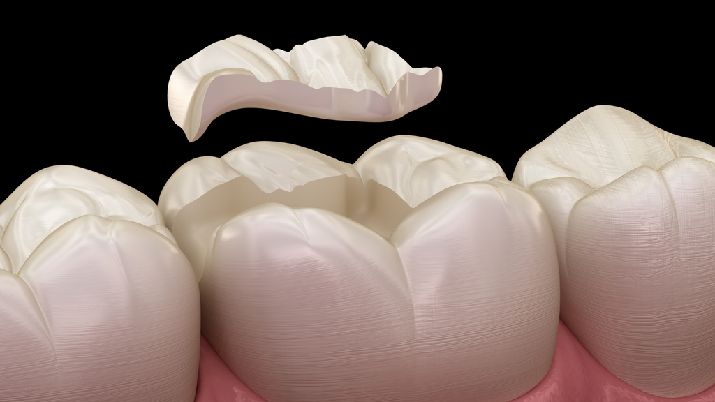 3D illustration showing a dental onlay being placed on a prepared molar tooth, with adjacent teeth and gum tissue visible against a black background.