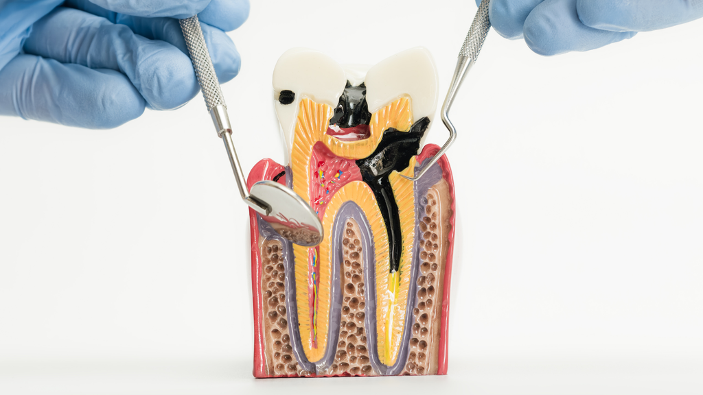 A dental model of a tooth with cavities and decay, held by gloved hands using dental tools, showing roots and internal structures.