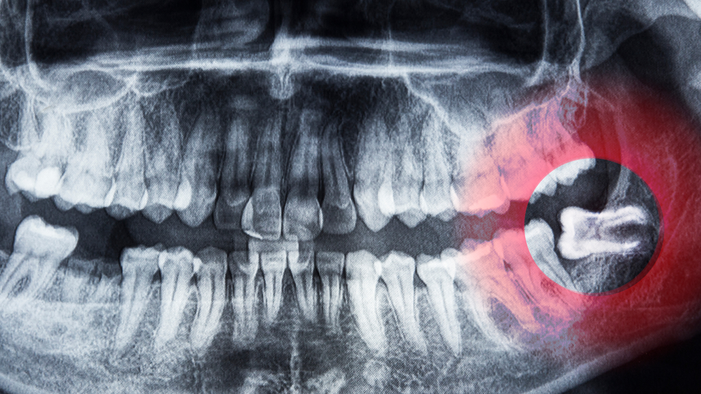 Dental X-ray showing impacted wisdom tooth on the lower right side, highlighted by a red circle for emphasis.